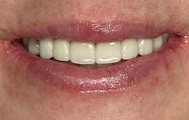 Healthy smile after dental restoration