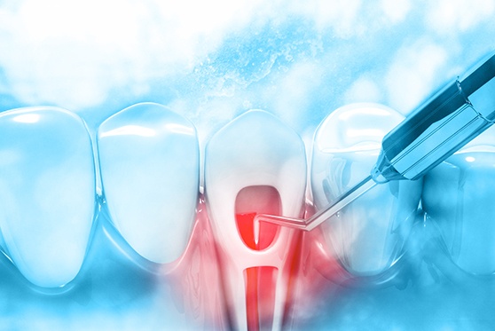 Illustration of root canal treatment performed on tooth in lower arch