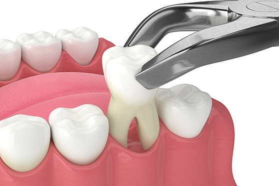 Illustration of tooth being extracted with forceps